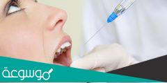 مدة انتهاء بنج الاسنان وكم يستمر مفعولة