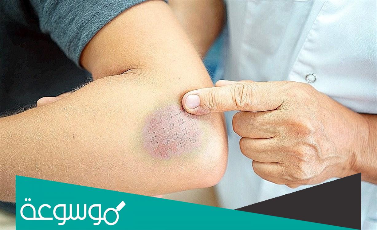 معلومات عن مرهم هيموكلار للكدمات