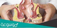 هل البواسير الخارجية خطيرة