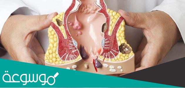 هل البواسير الخارجية خطيرة