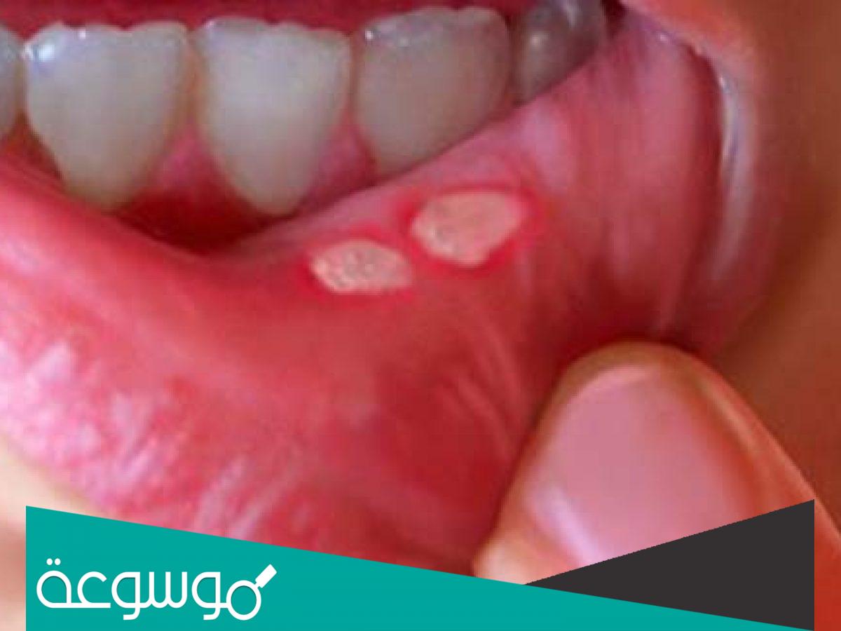 هل الليمون يقتل الفطريات ؟ .. ويعالج فطريات الفم