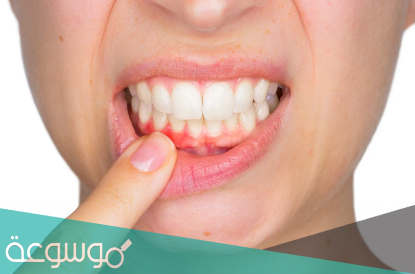 اعراض سرطان اللثة المبكرة وعلاجها