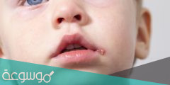 4 أسباب للقروح الباردة لدى الأطفال