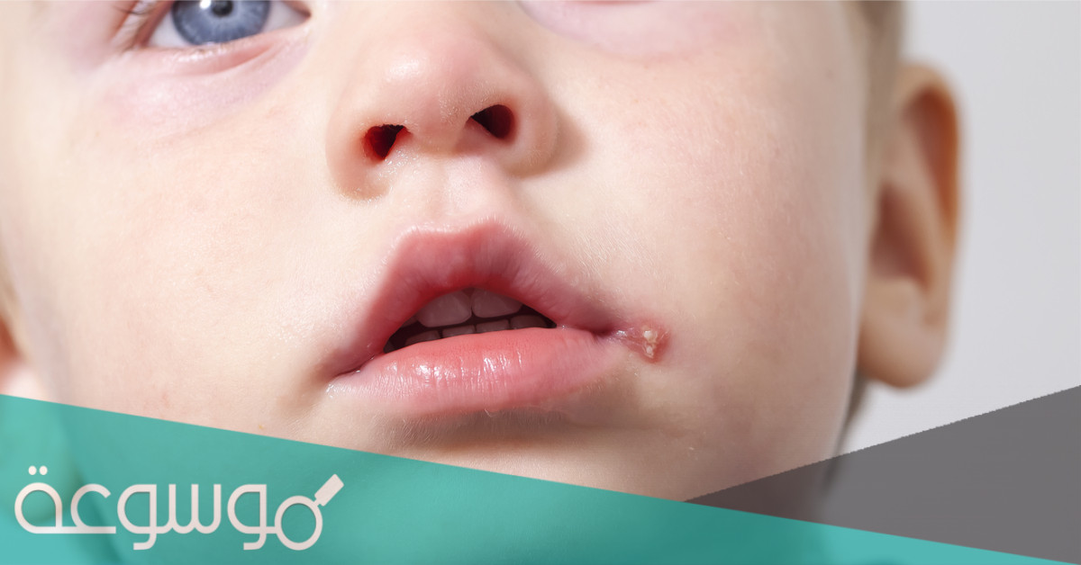 4 أسباب للقروح الباردة لدى الأطفال
