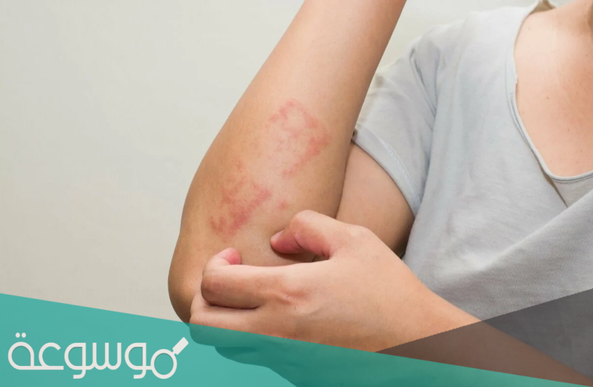 ماهي اعراض امراض الجلد الفطرية وعلاجها