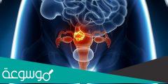 علامات سرطان بطانة الرحم وطرق علاجه