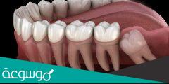 أسباب الأسنان المنغرسة 2022