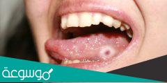 أسباب ظهور حبوب اللسان ومتى تكون خطيرة