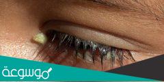 أسباب الإفرازات الصباحية للعين