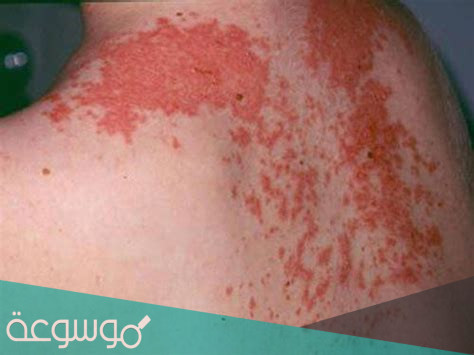 أعراض مرض القوباء الحصف الجلدي وأسبابه وطرق علاجه
