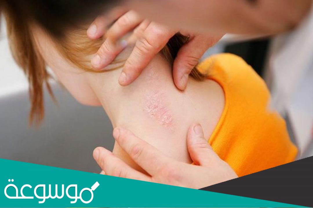 أنواع الصدفية و أعراض الإصابة بها