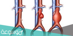 اعراض تصلب الشرايين في الشريان الاروطي البطني