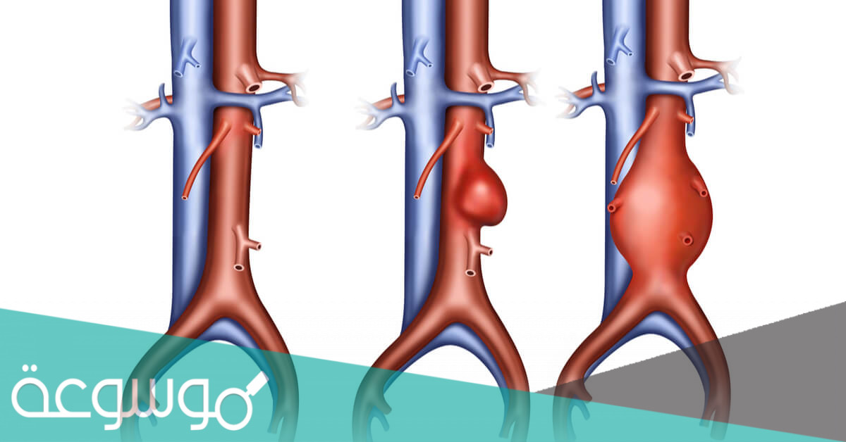 اعراض تصلب الشرايين في الشريان الاروطي البطني