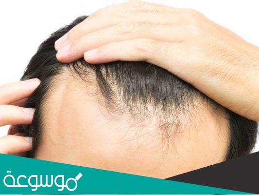 الامراض التى تسبب سقوط الشعر