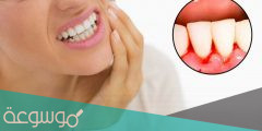 التهاب اللثة الخطية .. أعراضها وعلاجها