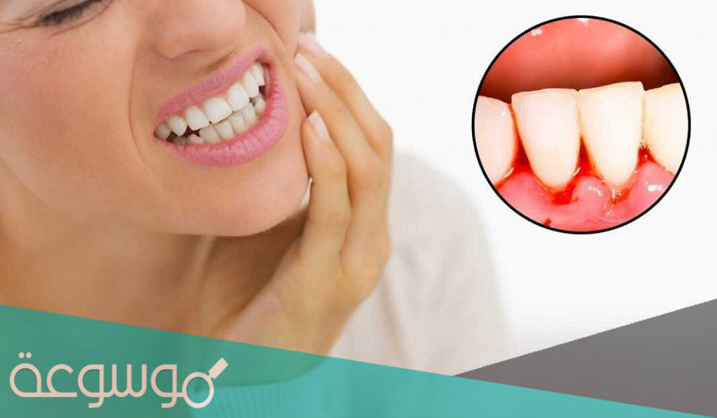 التهاب اللثة الخطية .. أعراضها وعلاجها