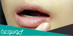 التهاب زوايا الشفاه