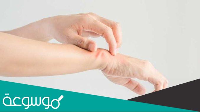 الطقس البارد وعلاقته بالاكزيما