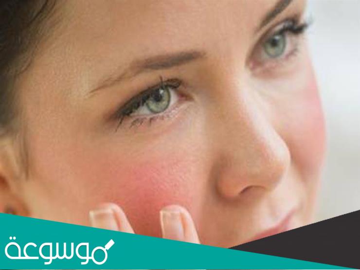 العلاقة بين نسبة الحديد في الجسم و احمرار الوجه