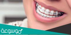 ما هو تقويم الاسنان و افضل عمر للتقويم