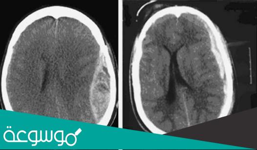 تفاصيل الإصابة بالورم الدموي فوق الجافية