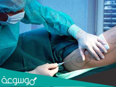 حدود عمليات شفط الدهون وما يجب أن تتوقعه