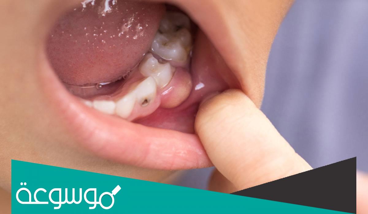 تفسير رؤية الضرس في المنام حسب تفسير ابن سيرين والنابلسي وابن شاهين