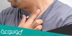 ما هي اسباب الزوائد الجلدية وطرق التخلص منها 2022