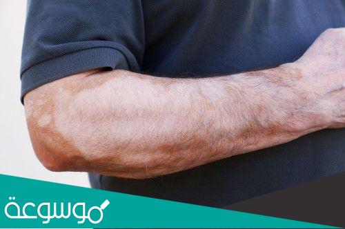 علاج طبيعي للنخالية المبرقشة