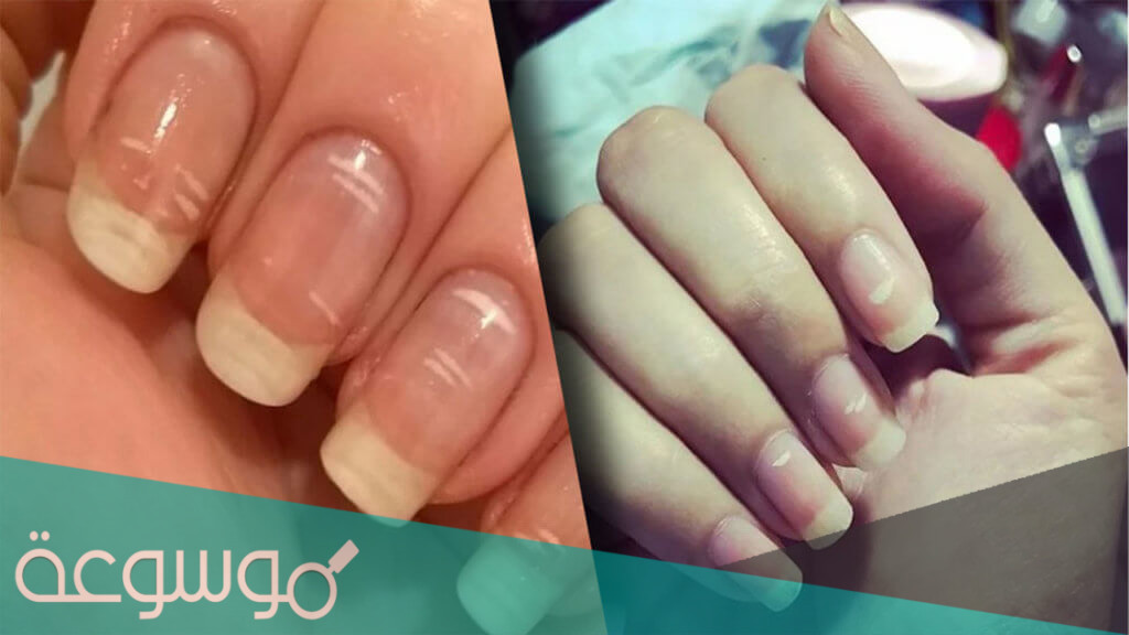 كيفية التخلص من البقع البيضاء في الاظافر