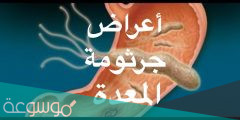 ما أعراض جرثومة المعدة بالتفصيل