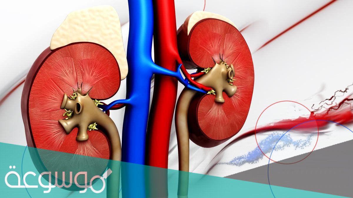 ما الذي ينتج عن توقف كلية شخص عن العمل