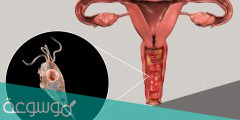 ما سبب التهابات الرحم وطرق علاجها