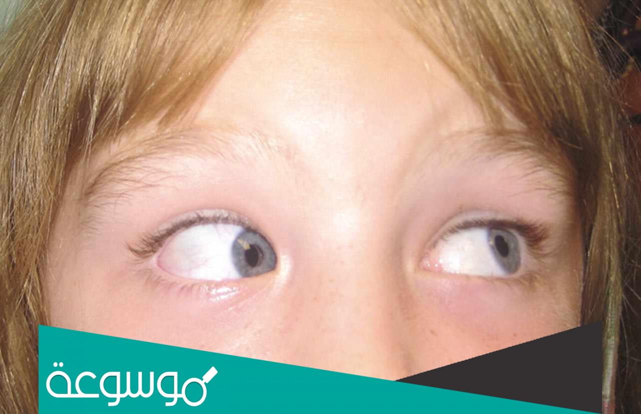 متلازمة براون و أسباب الإصابة بها