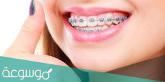 معلومات كاملة عن انواع تقويم الاسنان