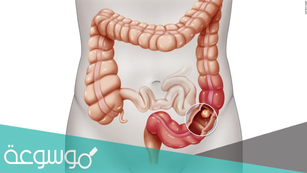 مكان القولون السيني والأمراض التي تصيبه