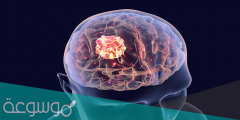 كيف يصاب بعض الاشخاص ببعض الاورام السرطانية في الدماغ