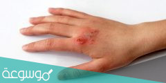 أسباب وعلاج حروق الدرجة الثانية