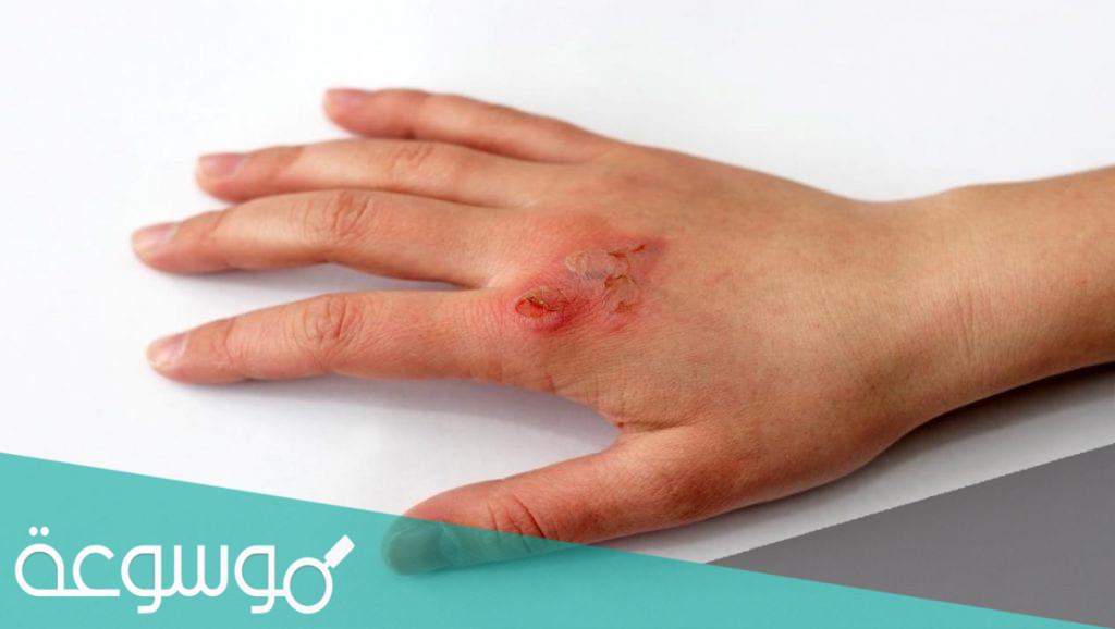 أسباب وعلاج حروق الدرجة الثانية