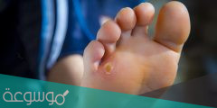 اعراض مسمار القدم وعلاجه مجرب