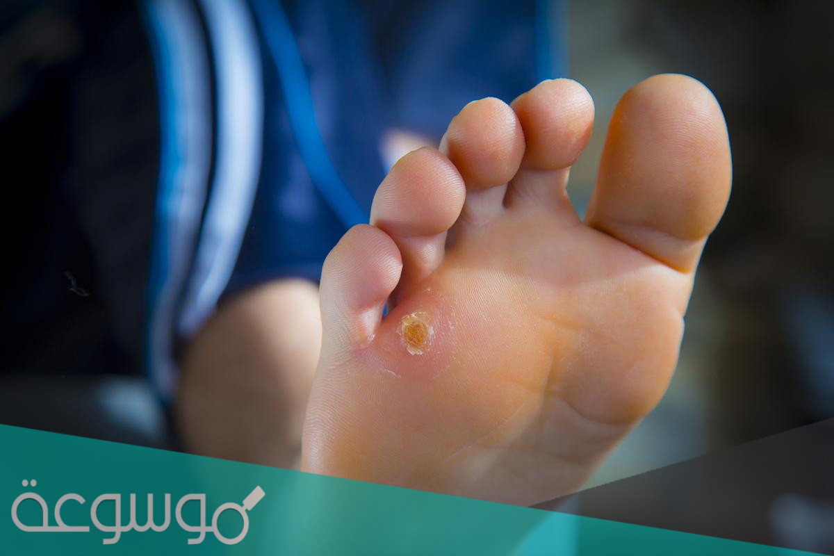 اعراض مسمار القدم وعلاجه مجرب