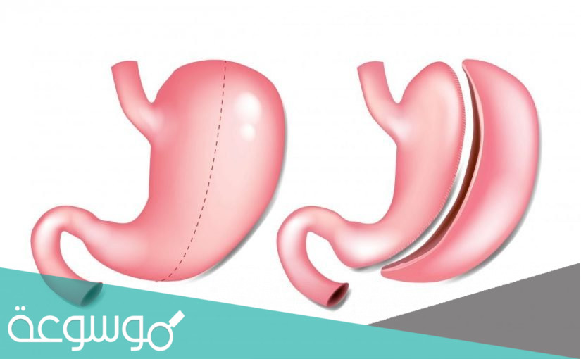 افضل دكتور تكميم في الرياض 2022