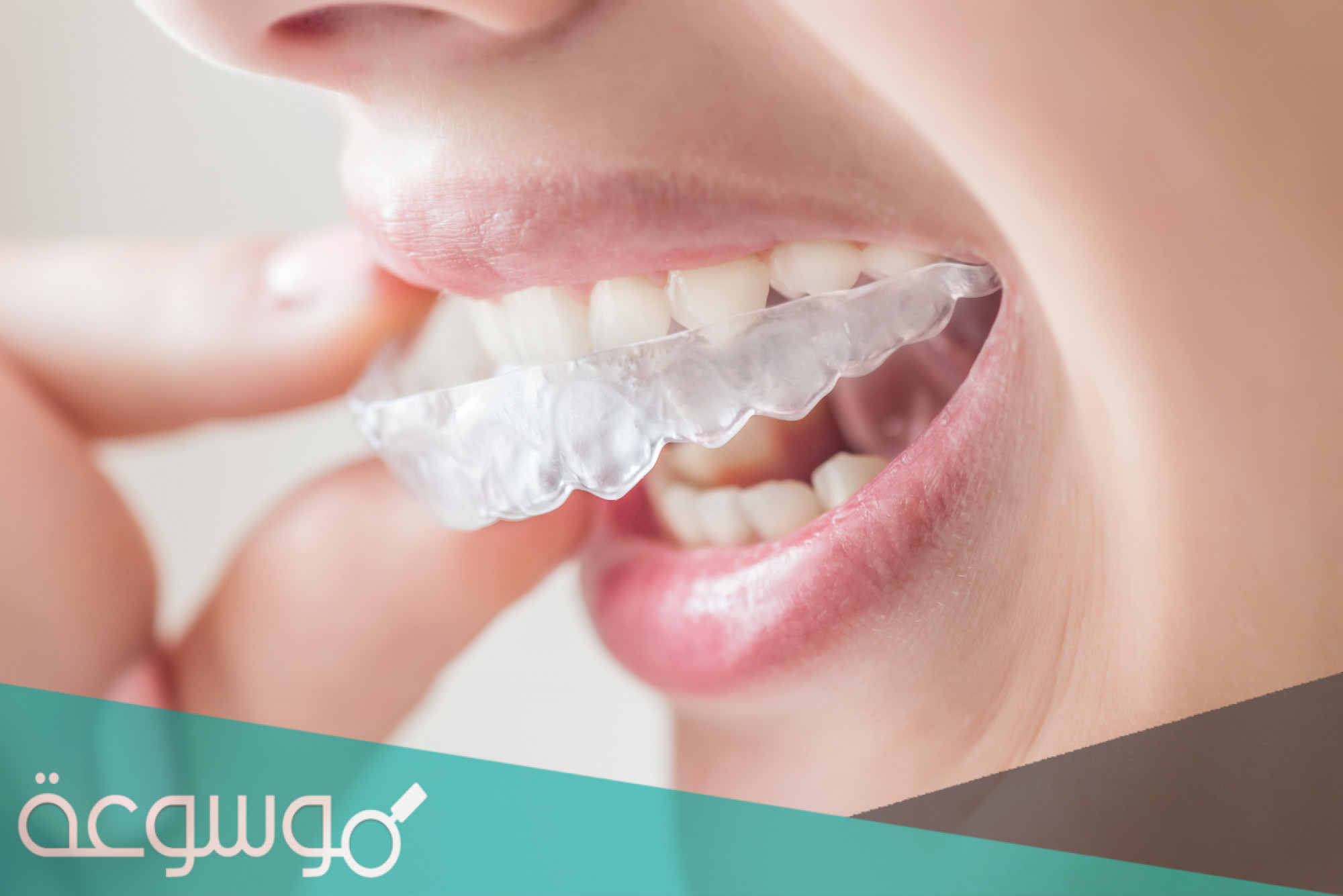 تجربتي مع تقويم الاسنان الشفاف