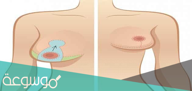 حل مشكلة عدم تساوي حجم الثديين