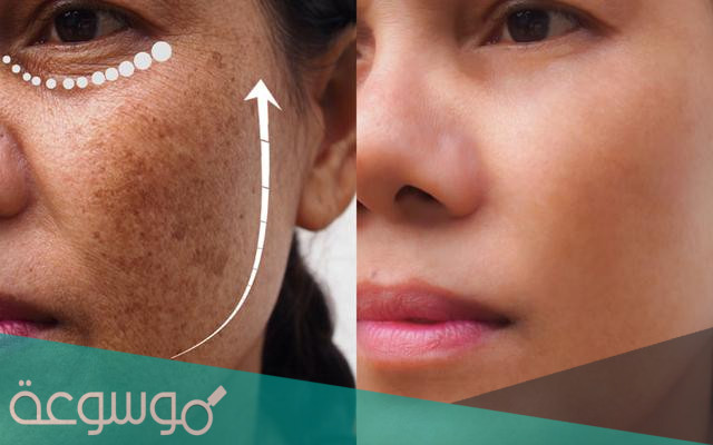 كريم هيدروكينون Hydroquinone لإزالة النمش والكلف