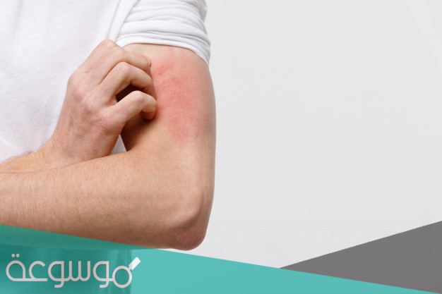 ما هي مسببات الحساسية