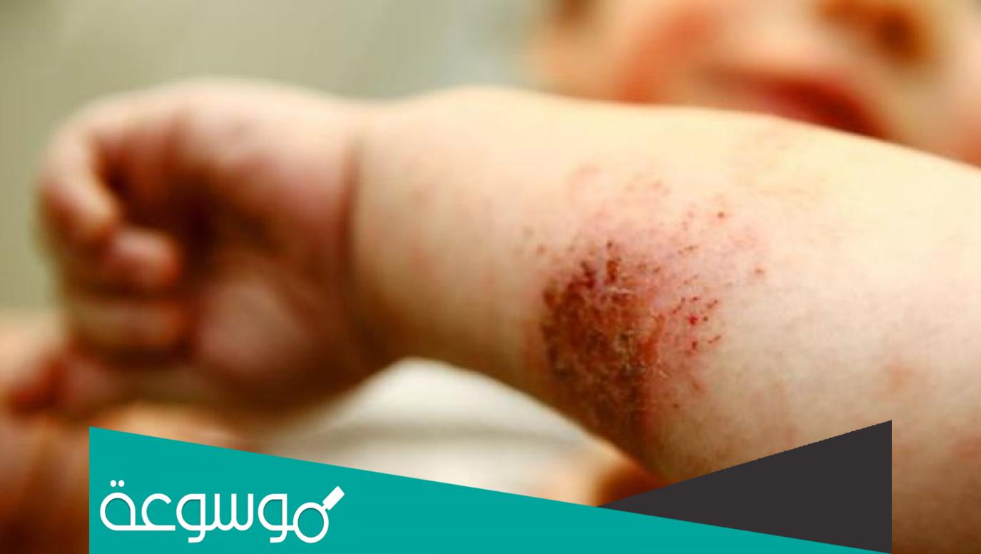 6 تطبيقات مفيدة لإدارة الأكزيما والتهاب الجلد