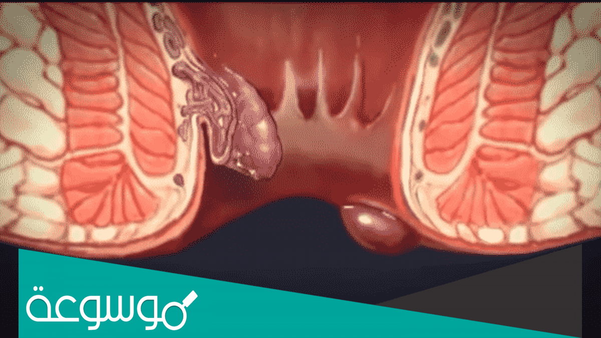 تجارب أفضل كريم لعلاج البواسير