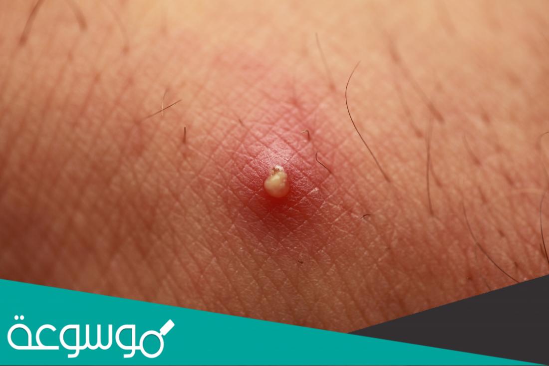 طريقة علاج الدمل مجرب ومضمون