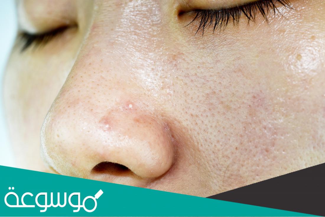 وصفات لتبيض الوجه الدهني
